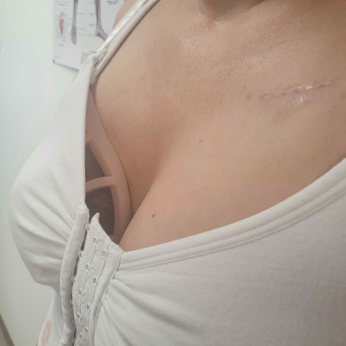 Patiente portant une Air'avanti